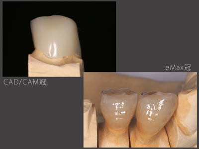 CAD/CAM冠　e-max冠　比較